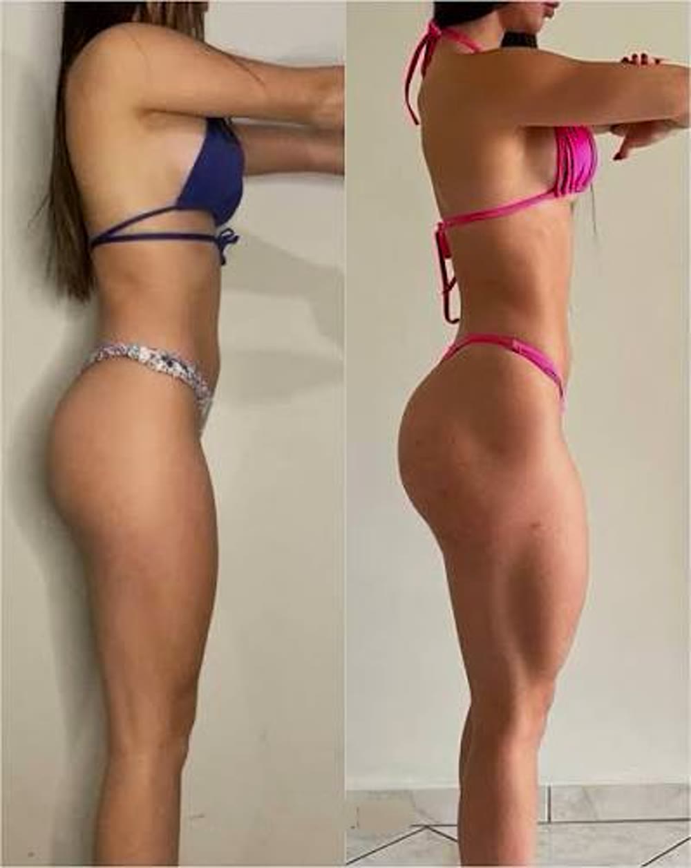 Antes e depois de aluna do Protocolo Bumbum Bonito